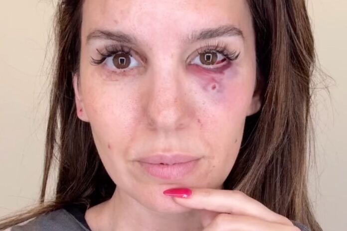 Christy Carlson Romano 'Shot in the Eye'